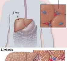 Znakovi hepatitisa C kod muškaraca. Simptomi, liječenje, prevencija