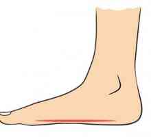 Uzdužni ravni stopalo 2 stupnja: dijagnoza, značajke liječenja