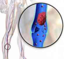Prevencija vaskularne tromboze: savjet stručnjaka
