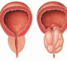 Prostatitis: znakovi kod muškaraca, liječenje i simptomi