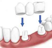 Protetski stomatologija u odsustvu velikog broja zuba: vrsta