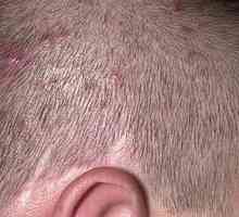 Akne na glavi u kosi: uzroci i liječenje