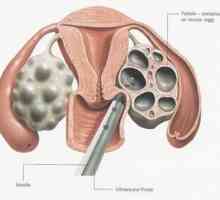 Probijanje folikula s IVF. Priprema za bušenje folikula