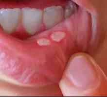 Mjehurići na usnama: uzroci i liječenje
