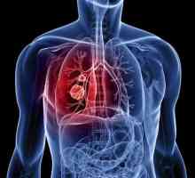Skvamozni karcinom pluća: opis, uzroci, dijagnoza i karakteristike liječenja