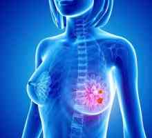 Rak dojke: simptomi i znakovi, faze bolesti