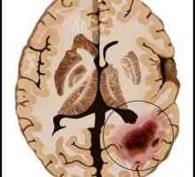 Rak mozga: uzroci, simptomi i dijagnoza