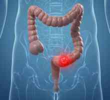 Rak debelog crijeva: simptom, stadij, liječenje, prognozu
