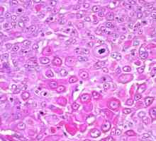 Karcinom pločastih stanica cerviksa: prognoza, liječenje