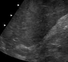 Dimenzije jetre su normalne u ultrazvuku (dekodiranje)