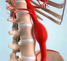 Ruptura aorte: uzroci, prva pomoć, posljedice