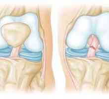Ruptura ligamenta koljena
