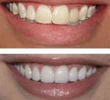 Obnova zuba: prije i poslije. Umjetna obnova zuba