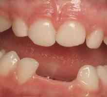 Zadržavanje je ono što je u stomatologiji?