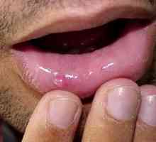 Retencija ciste donje usne: uzroci, liječenje