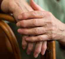 Reumatoidni artritis prstiju: prvi simptomi, uzroci i liječenje