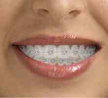 Self-ligating braces - njihove vrste i prednosti