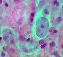 Najčešće infekcije su protozoalne