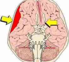 Kompresija mozga: vrste, simptomi, dijagnoza i liječenje