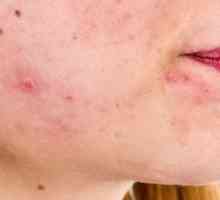 Seborrheic dermatitis na licu: liječenje, uzroci i prevencija