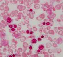 Sideroblastična anemija: simptomi, liječenje