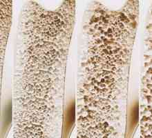 Simptomi i liječenje osteoporoze. Učinci i prevencija osteoporoze kod žena i muškaraca