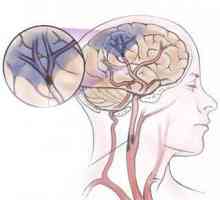 Simptomi i liječenje ishemijskog moždanog udara
