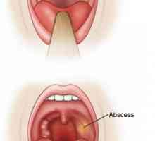 Simptomi paratonskih apscesa. Liječenje s narodnim lijekovima
