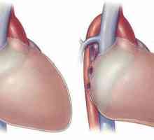 Simptomi srčanog perikarditisa i liječenja. Suhi perikarditis: Simptomi