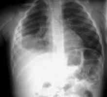 Simptomi upale pluća u dojenčadi. Liječenje, posljedice bolesti