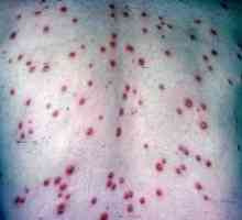 Simptomi sifilisa i prevencije