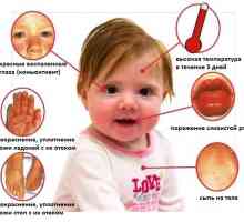Kawasaki sindrom u djece: uzroci i liječenje