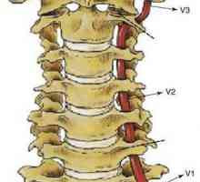 Sindrom vertebralne arterije s cervikalnom osteohondrozom: simptomi i liječenje