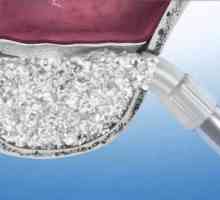 Podizanje sinusa: koristite za implantaciju zuba. Vrste, indikacije, moguće komplikacije