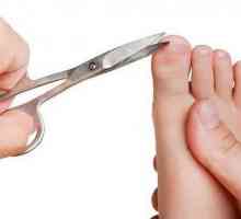 Staple Fraser - bezbolno liječenje uronjenog noktiju
