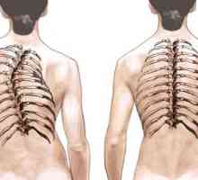 Scoliosis: liječenje kod odraslih. Značajke liječenja skolioze kod odraslih