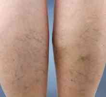 Vaskularna mreža na nogama: kako se riješiti, uzroci i karakteristike liječenja