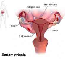 Spiralna `Mirena` na endometriozi: odgovori