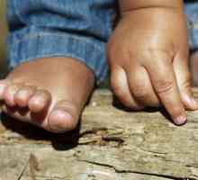 Osip na dlanovima i potplati djeteta: mogući uzroci i karakteristike liječenja