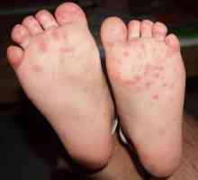Osip na nogama djeteta: dijagnoza, liječenje, prevencija