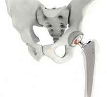 Hip joint: endoprostetika i daljnji oporavak