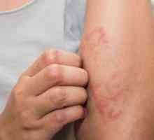 Toxicno-alergijski dermatitis: uzroci, simptomi, liječenje