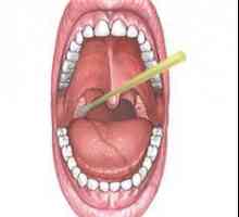 Tonsilitski čepovi: liječenje, uzroci i simptomi. Kako izgledaju zalisci tonsilita (fotografija)
