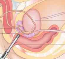 Transrektalni ultrazvuk prostate: opis, priprema i preporuke