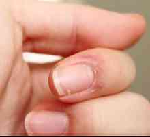 Puknuta koža na prstima blizu noktiju: uzroci i liječenje. Puknuta koža na nožnim prstima