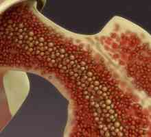 Trombocitopenija: uzroci, simptomi i liječenje