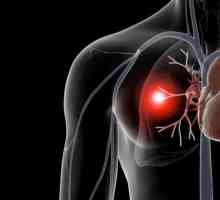 Tromboembolija plućne arterije: uzroci, dijagnoza, simptomi i liječenje