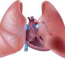 Trombi u plućima. Tromboembolija plućne arterije: uzroci, simptomi, učinci, liječenje