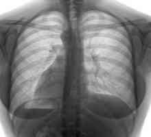 Tuberkuloza kralježnice: uzroci, simptomi, liječenje