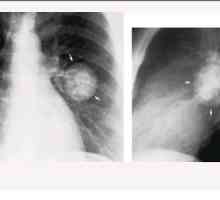 Tuberkuloza pluća - što je to? Liječenje, posljedice, recenzije